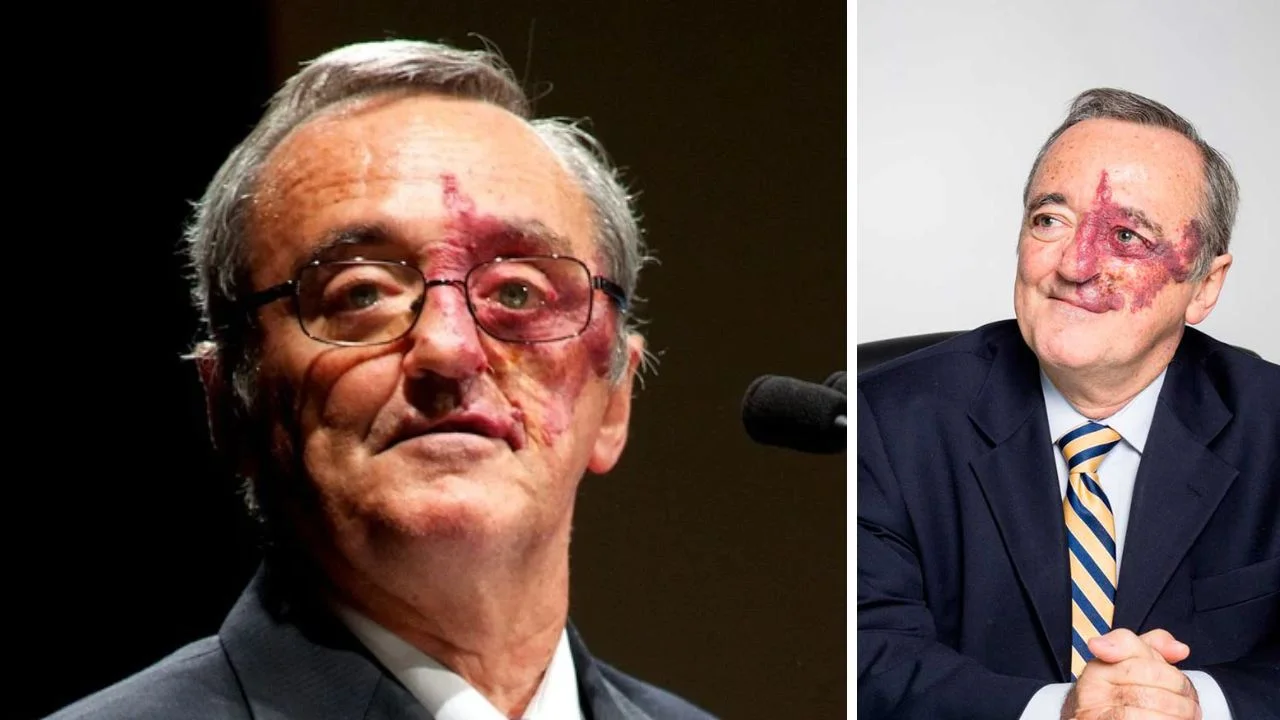 Mariano Barbacid mancha en la cara: ¿Tiene alguna enfermedad?